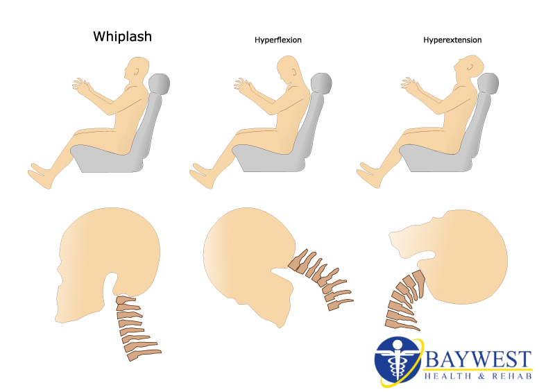 chiropractic care of whiplash