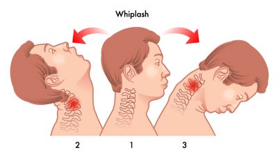 The Whiplash - What is it?